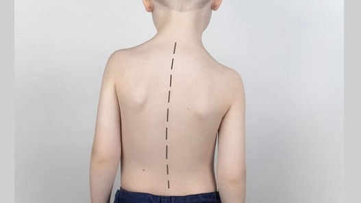Scoliosis in Kids: Answers to Common Questions That Every Parent Needs to Know