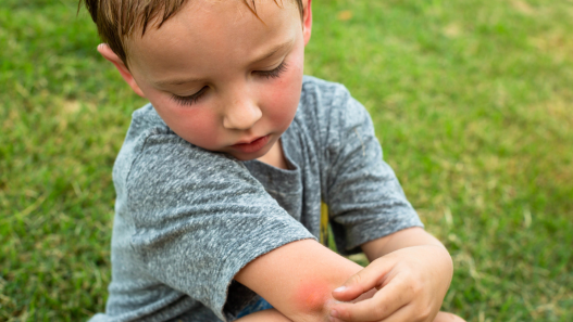 Boy sitting in grass with a mosquito bite on his elbow