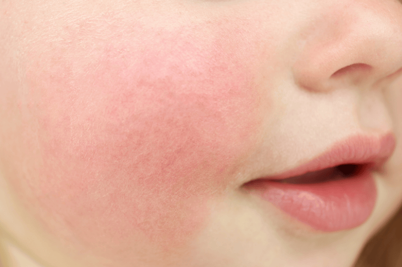 A close-up of a young child is red, ruddy cheeks