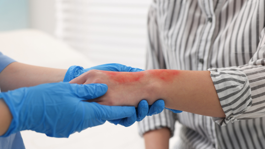 scald injury on arm being looked at 