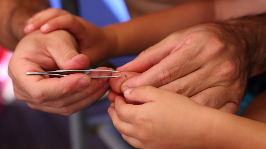 Removing Splinter Safely 