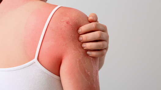 3 Sunburn Tips Every Parent Should Know 
