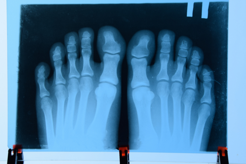 Picture of an X-Ray Scan of Toes
