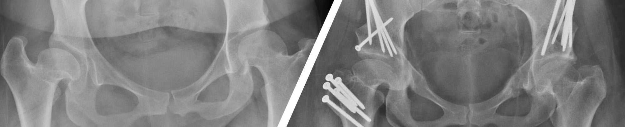 Programa para el Cuidado de la Cadera