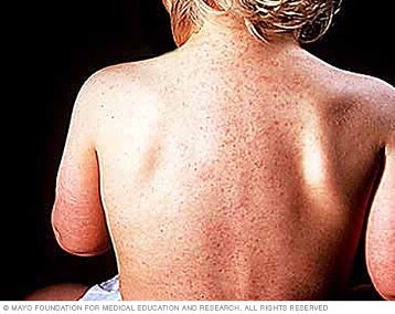 Roseola Infantum en la espalda